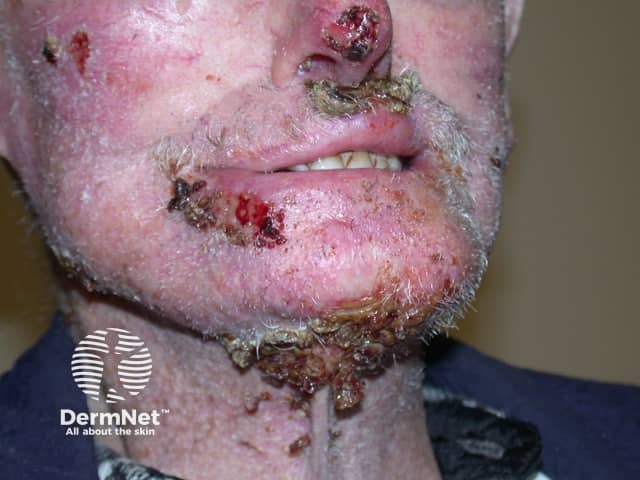 Basal cell carcinoma affecting the face