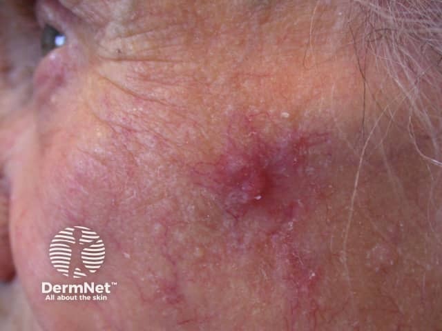 Basal cell carcinoma affecting the face