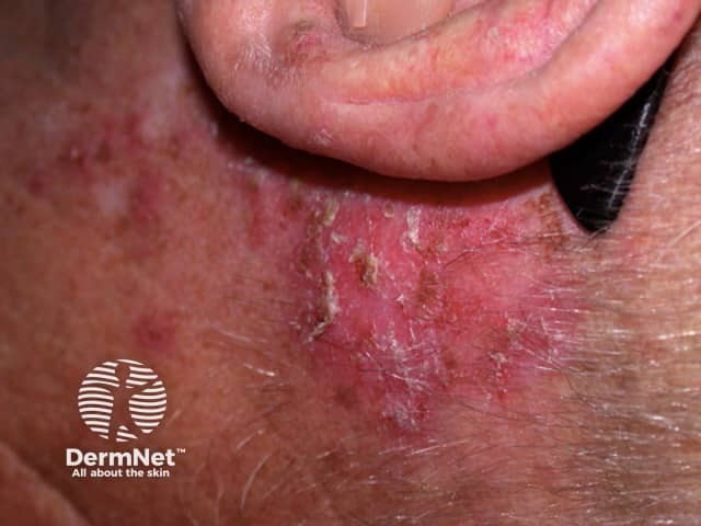 Basal cell carcinoma affecting the face