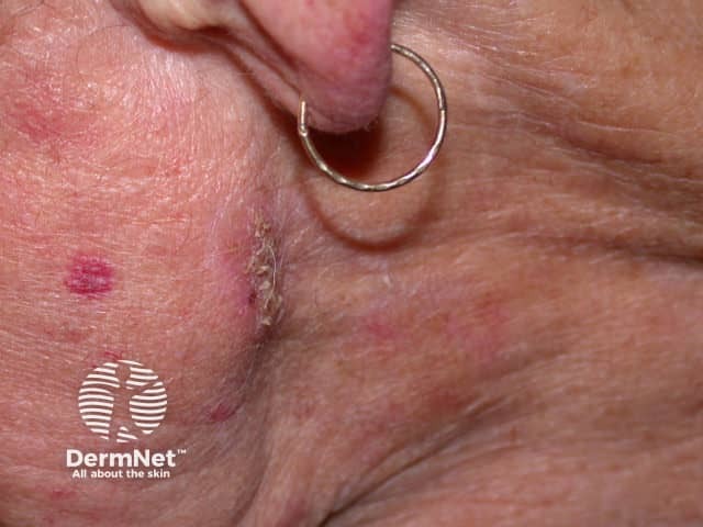 Basal cell carcinoma affecting the face