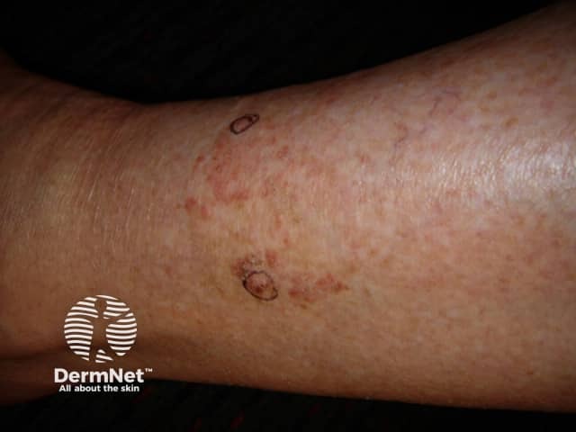 Actinic keratoses affecting the legs and feet