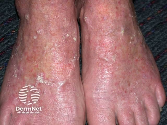 Actinic keratoses affecting the legs and feet