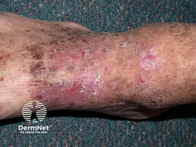 Actinic keratoses affecting the legs and feet