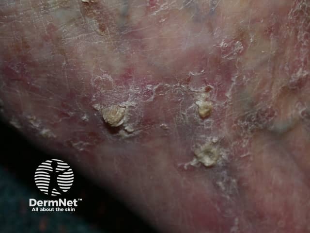 Actinic keratoses affecting the legs and feet