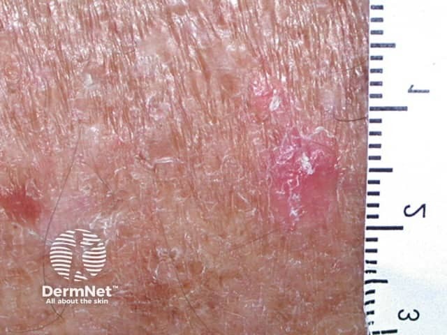 Actinic Keratoses affecting the legs and feet