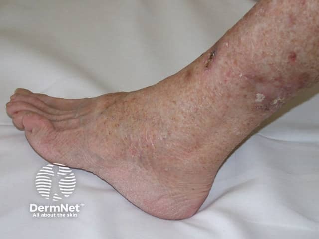 Actinic keratoses affecting the legs and feet