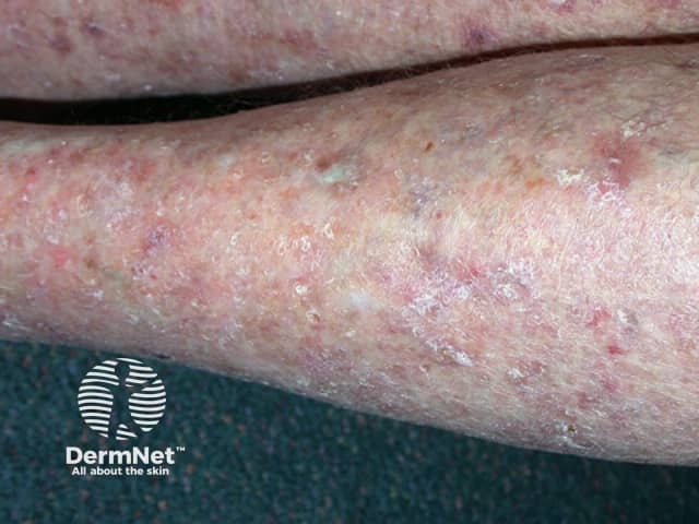 Actinic Keratoses affecting the legs and feet