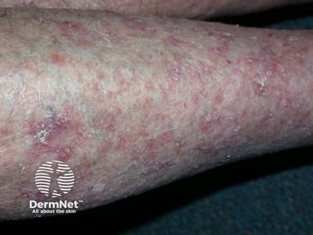 Actinic Keratoses affecting the legs and feet