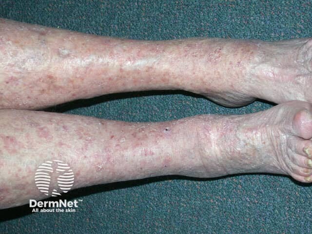 Actinic Keratoses affecting the legs and feet