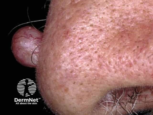 Basal cell carcinoma affecting the nose