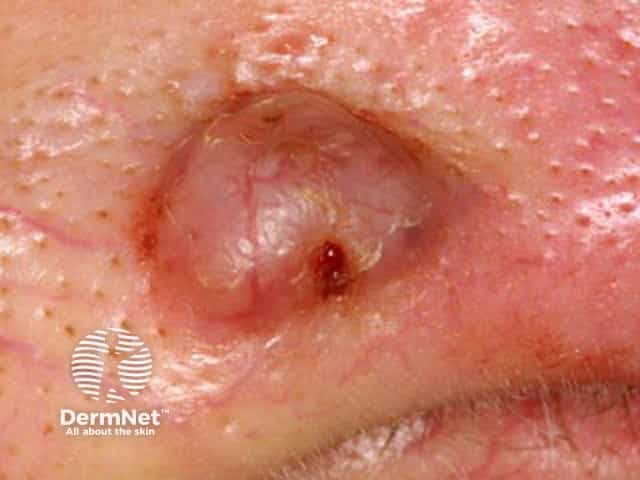 Basal cell carcinoma affecting the nose