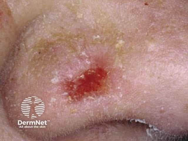 Basal cell carcinoma affecting the nose