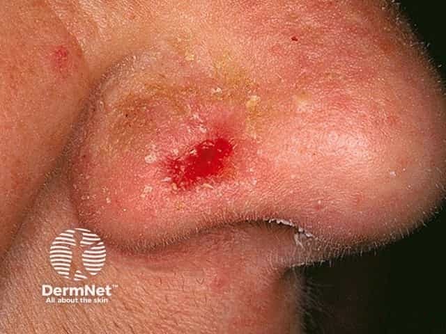 Basal cell carcinoma affecting the nose