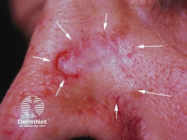 Basal cell carcinoma affecting the nose