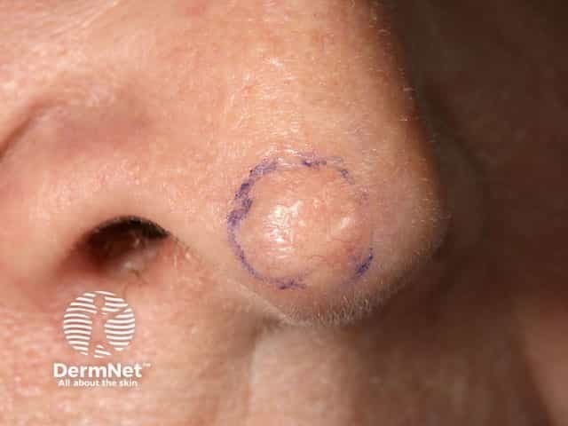 Basal cell carcinoma affecting the nose