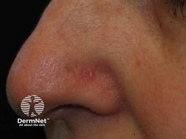 Basal cell carcinoma affecting the nose