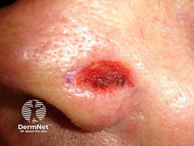 Basal cell carcinoma affecting the nose