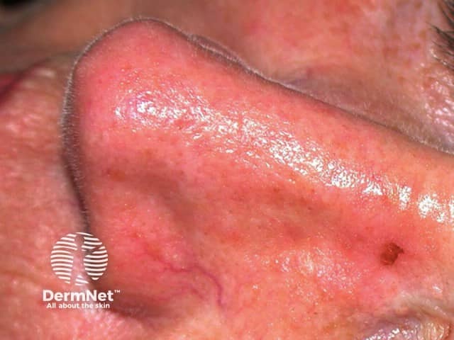 Basal cell carcinoma affecting the nose