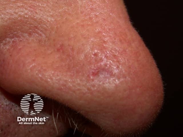 Basal cell carcinoma affecting the nose