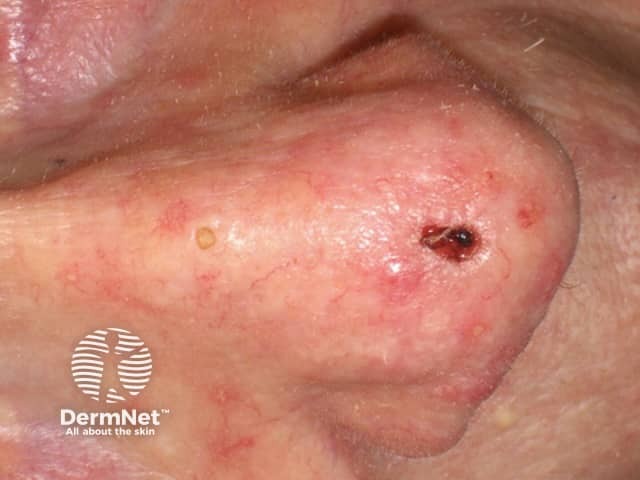 Basal cell carcinoma affecting the nose