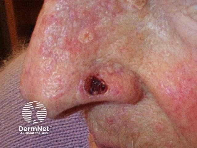 Basal cell carcinoma affecting the nose