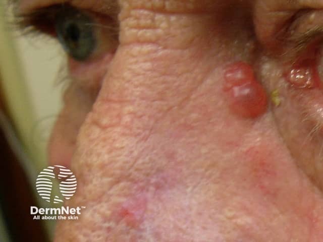 Basal cell carcinoma affecting the nose