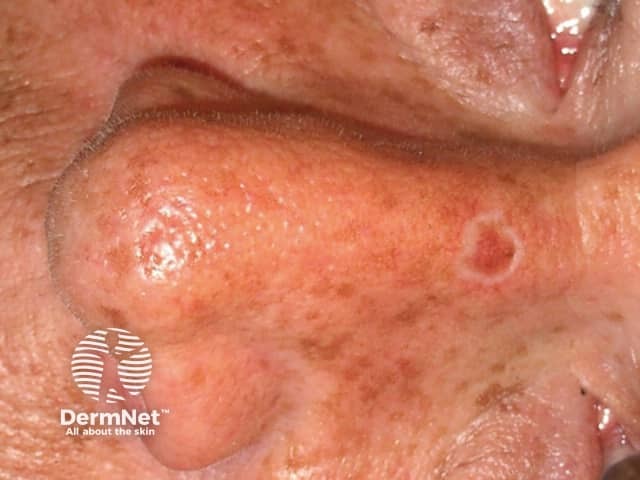 Basal cell carcinoma affecting the nose