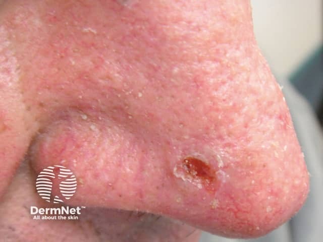 Basal cell carcinoma affecting the nose