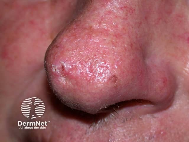 Basal cell carcinoma affecting the nose