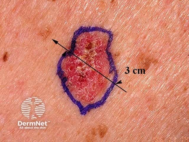 Basal cell carcinoma affecting the trunk