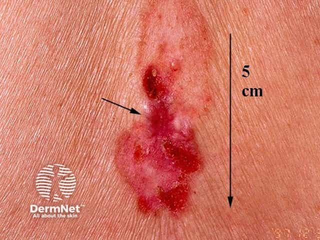 Basal cell carcinoma affecting the trunk