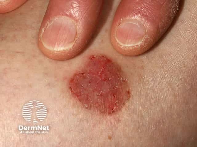 Basal cell carcinoma affecting the trunk