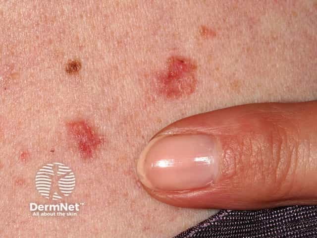 Basal cell carcinoma affecting the trunk