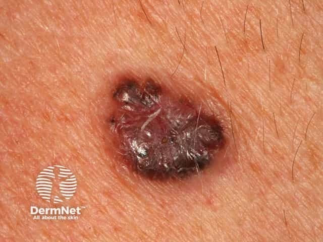 Basal cell carcinoma affecting the trunk