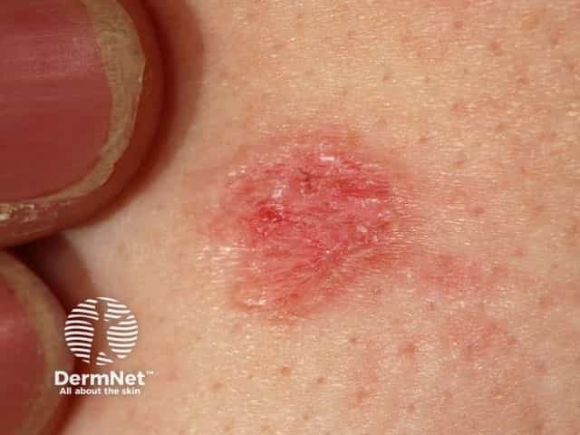 Basal cell carcinoma affecting the trunk