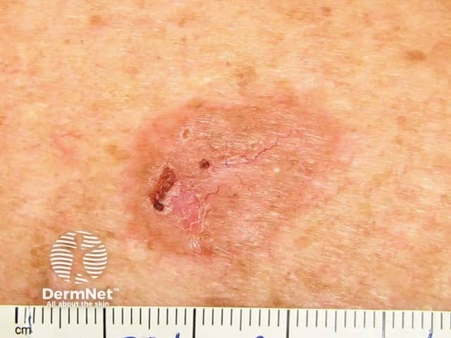 Basal cell carcinoma affecting the trunk