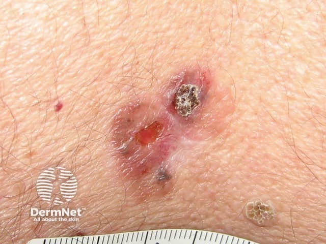 Basal cell carcinoma affecting the trunk