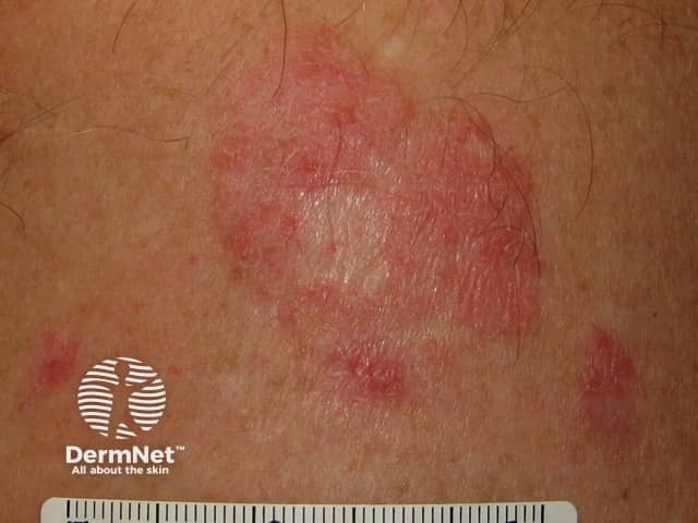 Basal cell carcinoma affecting the trunk