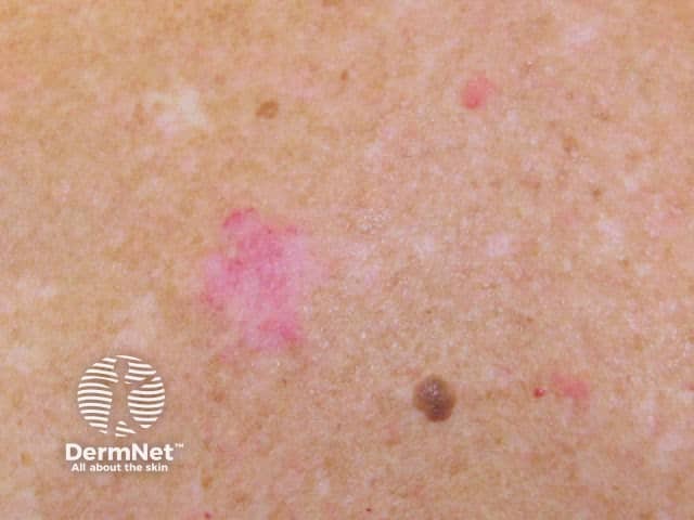 Basal cell carcinoma affecting the trunk