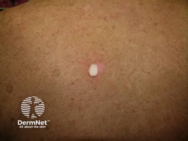 Basal cell carcinoma affecting the trunk