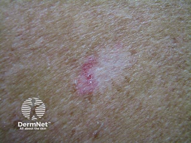 Basal cell carcinoma affecting the trunk