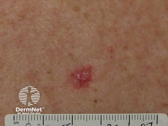 Basal cell carcinoma affecting the trunk