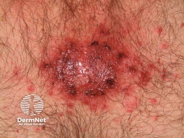 Basal cell carcinoma affecting the trunk