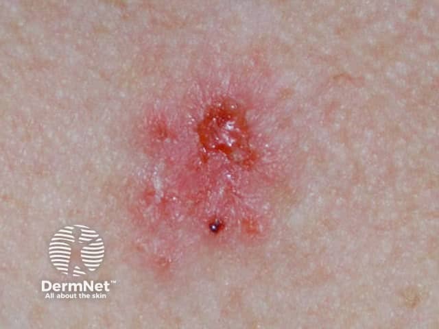 Basal cell carcinoma affecting the trunk