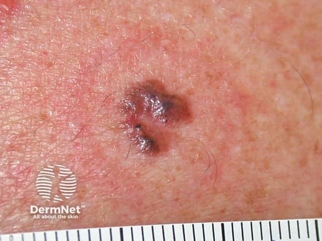 Basal cell carcinoma affecting the trunk