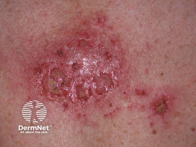 Basal cell carcinoma affecting the trunk