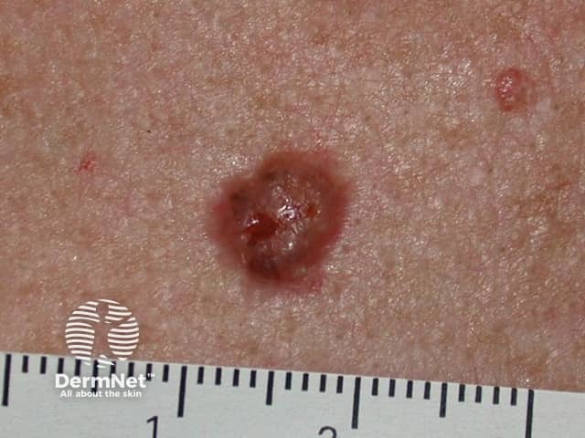 Basal cell carcinoma affecting the trunk