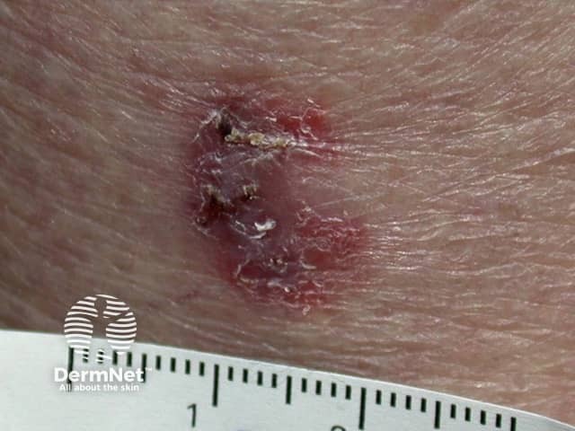 Basal cell carcinoma affecting the trunk