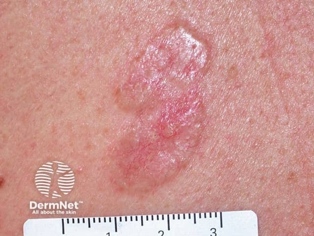 Basal cell carcinoma affecting the trunk