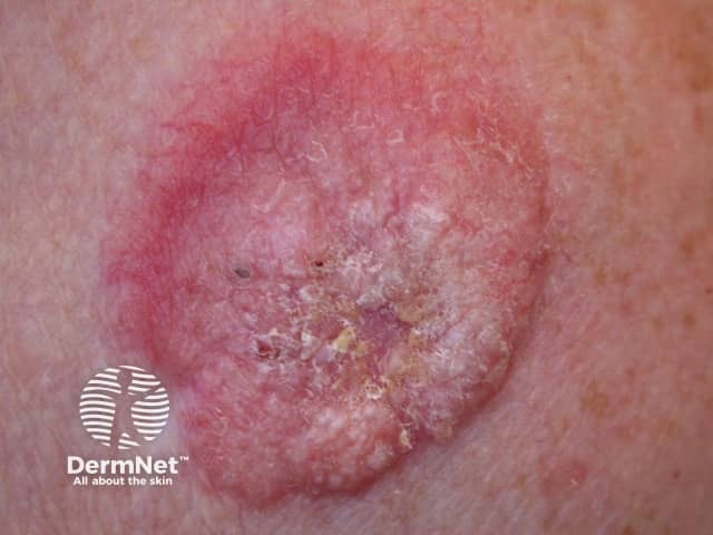 Basal cell carcinoma affecting the trunk